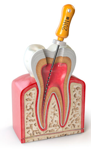 studidentisticiperassi-AdobeStock_283201199 Endodonzia